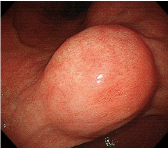 下 腫瘍 粘膜 胃粘膜下腫瘍の症状・原因・対処法 Doctors